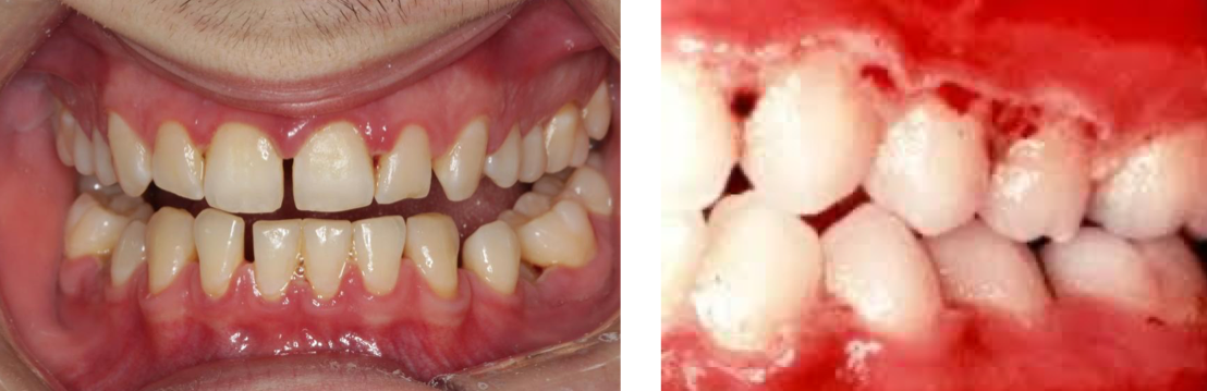 <ul><li><p>Rapid, painful onset. Soft tissue necrosis/ulceration with malodor </p></li><li><p>Linked to spirochetes, Prevotella Intermedia, stress, smoking. Peak in late teens/20s </p></li><li><p>Managed via ultrasonic debridement, NSAIDs, penicillin/metronidazole</p></li></ul><p></p>