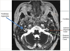 <p>Cochlea sits in __________________________, while vestibular system sits in _______________________.</p>