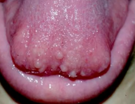 <p>benign neural neoplasm associated with MULTIPLE NEUROENDOCRINE NEOPLASIA types 2B (MEN2B) </p>