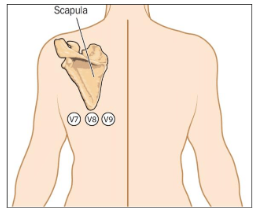 <p><span>If there is a need for V7, V8 and V9 they just wrap around the left posterior ending with…</span></p>