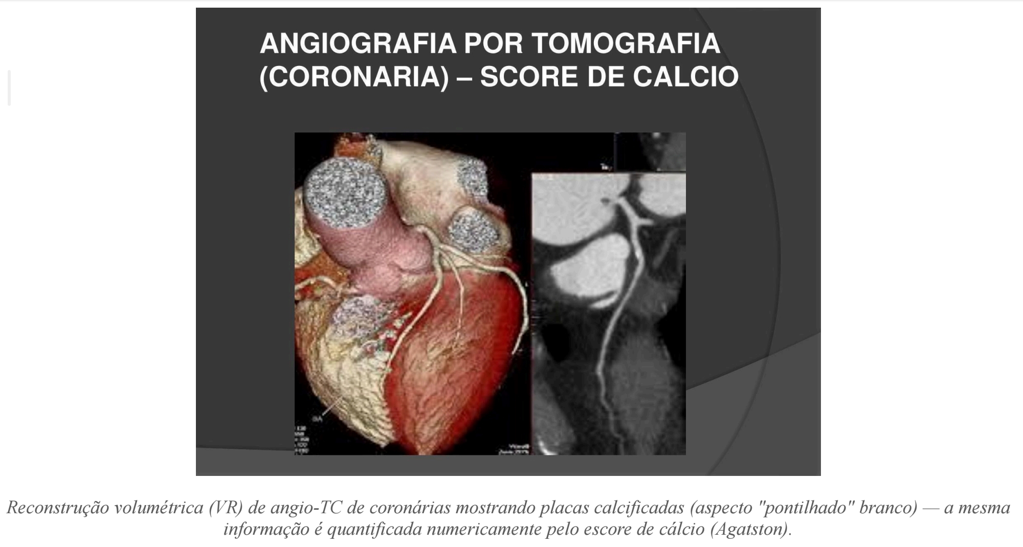 <p>O que essas placas calcificadas em aspecto pontilhado branco representam?</p>