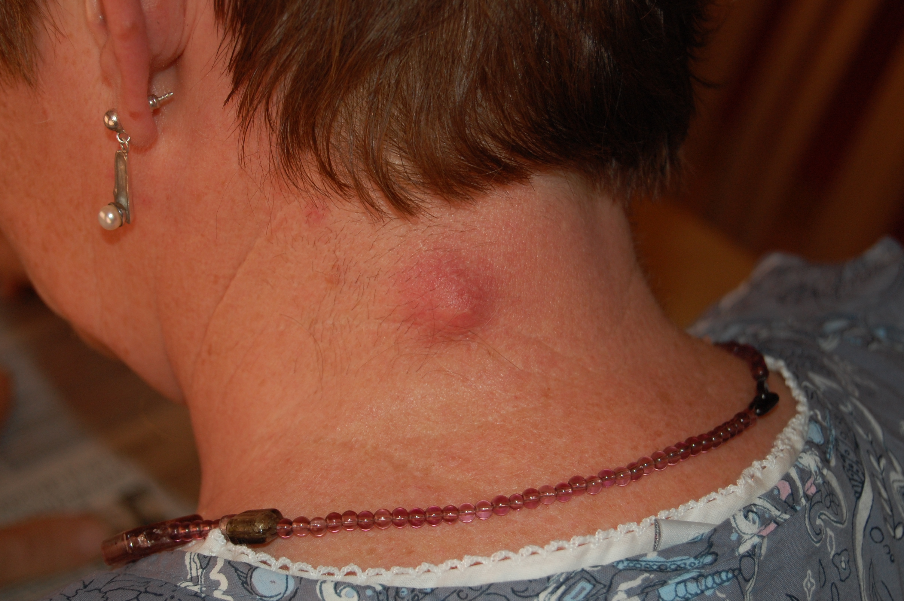 <p>A benign cyst filled with keratin.</p>