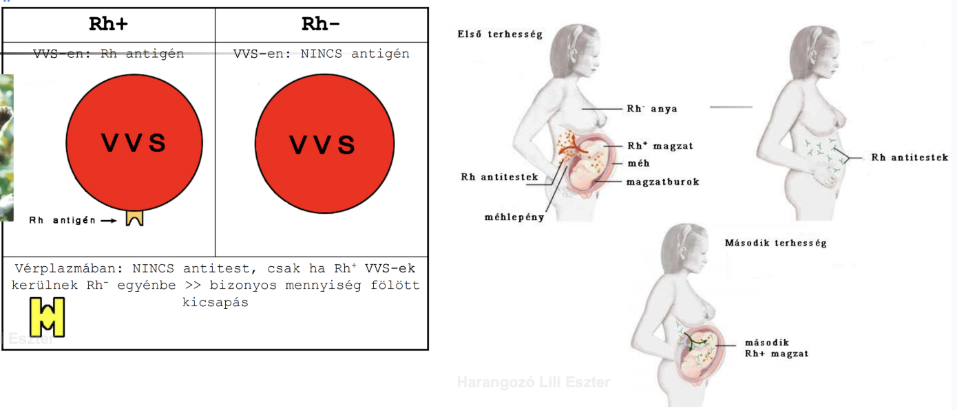 <ul><li><p><span style="background-color: transparent;">A D antigént vizsgálja a vörösvérsejteken</span></p></li><li><p><span style="background-color: transparent;">Fehérje, nem cukor, nagyon immunogén (erősen kivált antitest választ)</span></p></li><li><p><span style="background-color: transparent;">Ha egy Rh− személy véráramába Rh+ vörösvérsejtek kerülnek:</span></p><ul><li><p><span style="background-color: transparent;">Első találkozáskor: immunválasz lassan kialakul → anti-D antitest képződik, de nem mindig okoz azonnali reakciót</span></p></li><li><p><span style="background-color: transparent;">Második találkozáskor (vagy nagyobb mennyiség): az anti-D antitestek reakcióba lépnek a Rh+ vörösvérsejtekkel → <strong><em>hemolízis</em></strong> (vörösvérsejt szétesés), kicsapás történik</span></p></li></ul></li></ul><ul><li><p><span style="background-color: transparent;">Klinikai jelentőség: terhességben</span></p><ul><li><p><span style="background-color: transparent;">Rh− anya + Rh+ magzat → a magzat vérsejtjei immunizálhatják az anyát → második terhességben magzati hemolízis (újszülött sárgaság, anaemia)</span></p></li><li><p><span style="background-color: transparent;">Megelőzés: anti-D immunoglobulin adása a szülés után</span></p></li></ul></li></ul><p></p>