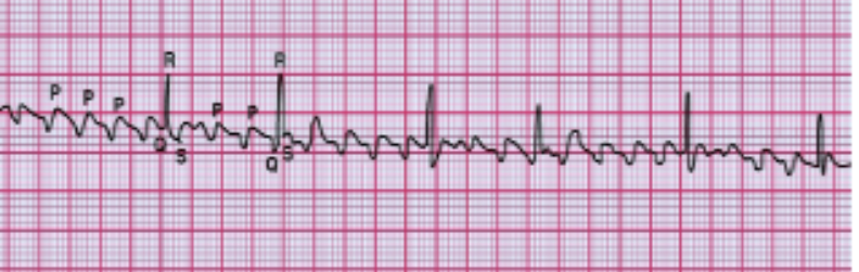 <p>What does this EKG indicate? </p>
