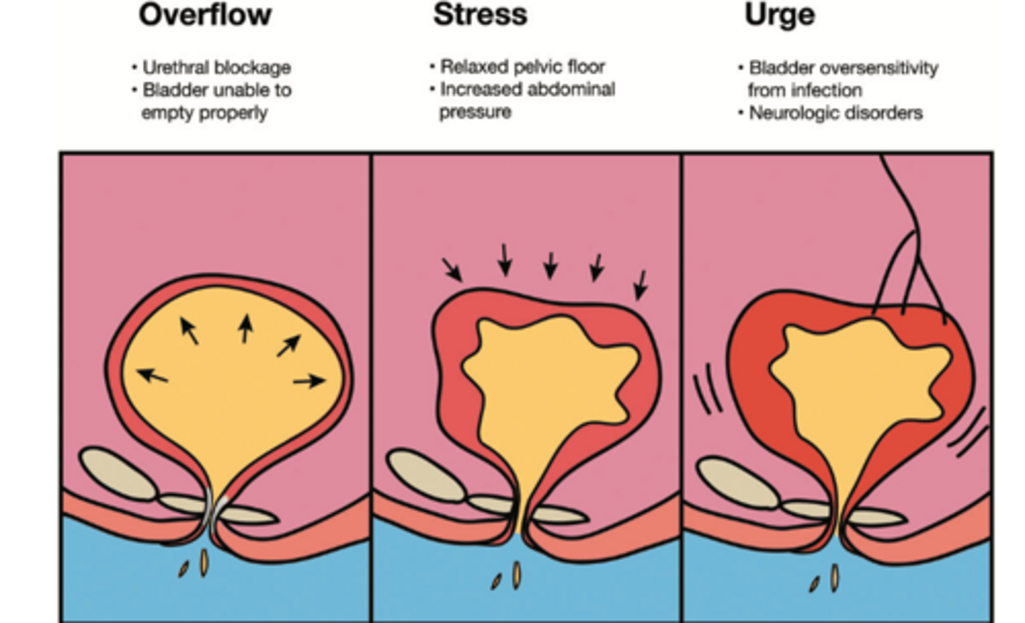 <p>sudden involuntary leakage of urine during cough or exercise (increase in pressure)</p><p>➤ Due to muscle weakness or laxity</p><p>➤ Treatment: Pelvic floor strengthening; Electrical stimulation and biofeedback therapy for pelvic floor muscles</p>