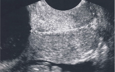 <ul><li><p>GOLD STANDARD method</p></li><li><p>bladder is empty</p></li><li><p>define cervical canal—take close-up shot (75% of screen)</p></li><li><p>measure length from internal os to external os</p><ul><li><p>if cervix is curved, use <em>trace</em> or obtain two or more linear measurements then add them together</p></li></ul></li></ul><p></p>