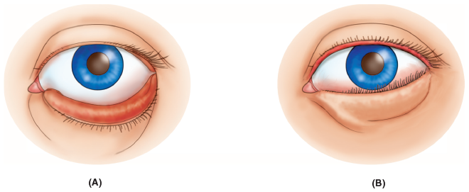 <p>eversion of the edge of an eyelid </p>