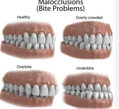<p>term to define how upper and lower teeth meet when closing the jaws </p>
