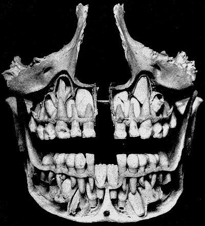 <p>“Baby teeth.” Two incisors, one canine, and two molars on each quarter, adding up to 20 total. No premolars</p>