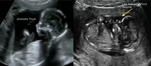 <p>which has subjectively less AF?</p>