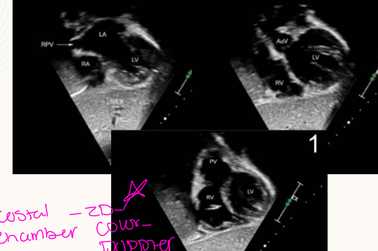 <p>Subcostal 4 chamber, 2 chamber AV opening, RVOT, utlizing 2D, Color, and doppler</p><p>What is the probe indicator direction in the subcostal Right Anterior Oblique view?<br>→ 2 o’clock</p><p>What structures are visualized simultaneously in the subcostal Right Anterior Oblique view?<br>→ RV inflow and RV outflow</p><p>What valve is displayed en face in the subcostal Right Anterior Oblique view?<br>→ Aortic valve</p>