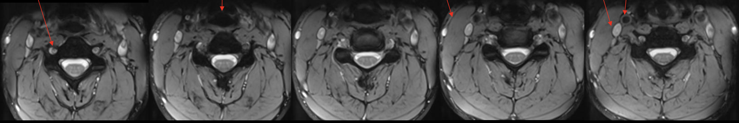 <p><span>椎动脉</span></p>