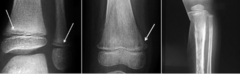 <p>What is this?</p><p>- 2-5 yo</p><p>- Pain (joint pain/ fever)</p><p>- Widespread</p>