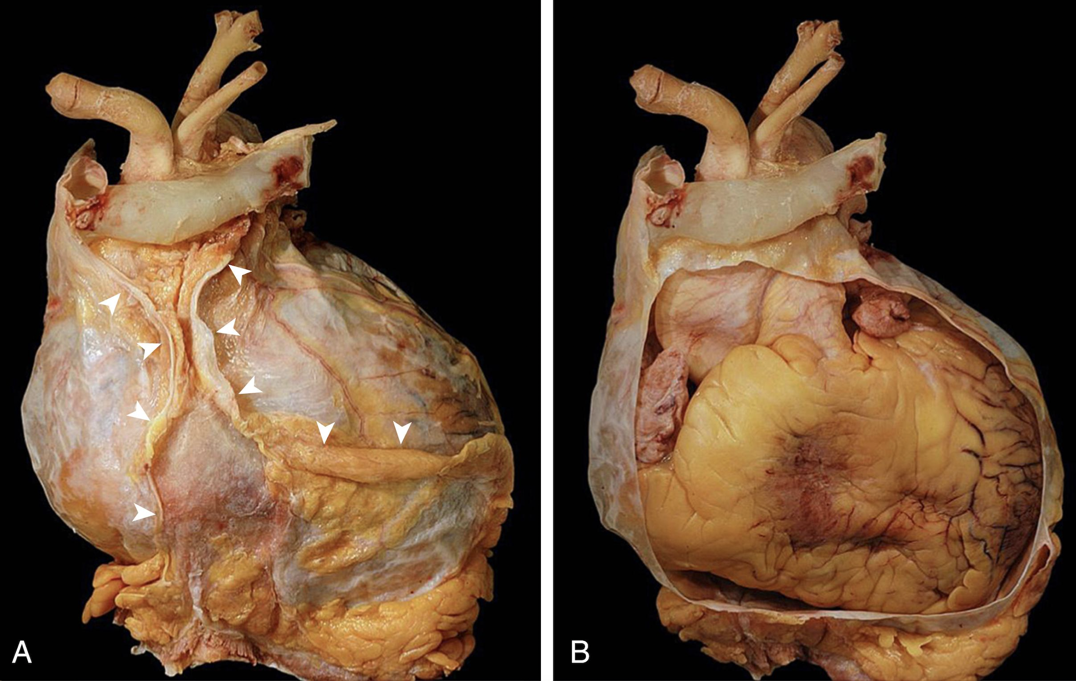 <p>Identify the feature of the heart</p>