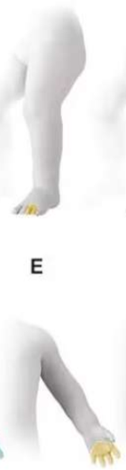 <p>this limb deficiency would be considered ___________</p>