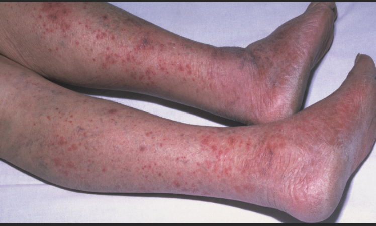 <ol><li><p><span style="color: rgb(38, 165, 151);"><strong>+ Brudzinski’s sign</strong></span></p></li><li><p><span style="color: rgb(38, 165, 151);"><strong>+ Kernigs sign</strong></span></p></li><li><p><span style="color: rgb(232, 48, 210);"><strong>petechiae or purpuric rash</strong></span> (meningococcal infx)</p></li><li><p><span style="color: rgb(182, 112, 46);"><strong>joints </strong></span>are involved (Hib and meningococcal infx)</p></li><li><p>chronic <span style="color: rgb(81, 101, 224);"><strong>ear draining</strong></span> (pneumococcal infx)</p></li></ol><p><span style="color: rgb(233, 92, 92);">common s/s: (7)</span></p><ol><li><p><span style="color: rgb(233, 92, 92);">seizures</span></p></li><li><p><span style="color: rgb(233, 92, 92);">nuchal rigidity</span></p></li><li><p><span style="color: rgb(233, 92, 92);">fever/chills</span></p></li><li><p><span style="color: rgb(233, 92, 92);">HA</span></p></li><li><p><span style="color: rgb(233, 92, 92);">confused</span></p></li><li><p><span style="color: rgb(233, 92, 92);">vomit</span></p></li><li><p><span style="color: rgb(233, 92, 92);">irritable/restless</span></p></li></ol><p></p>