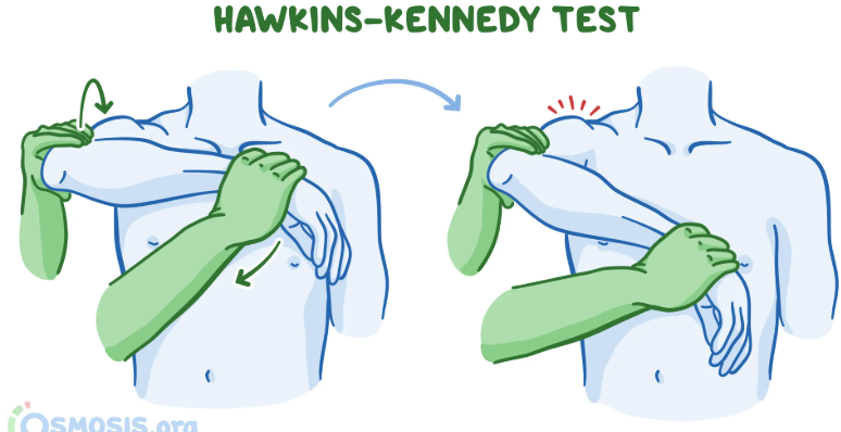 <p>Lift the arm straight in front to shoulder height. Bend the elbow so the hand points forward. Then push the hand downward. Pain is positive.</p><p>This test evaluates for shoulder impingement, specifically involving the supraspinatus tendon and subacromial bursa. </p>