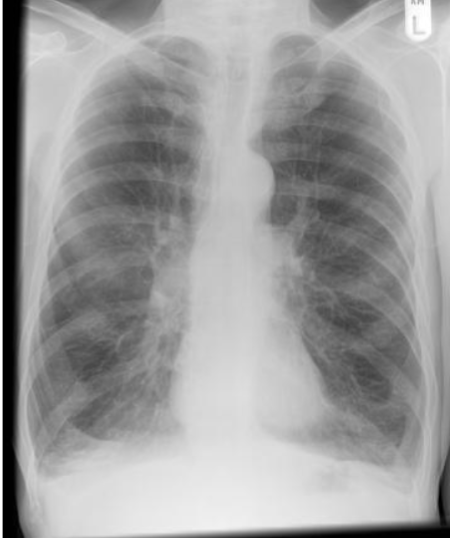 <p>Identify the pathology shown on the chest x-ray.</p>