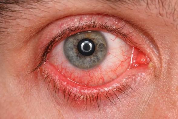 <p>Inflamación de la conjuntiva, la membrana transparente que recubre el interior de los párpados y la parte blanca del globo ocular</p>
