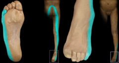 <p>Lateral foot, plantar aspect of foot, gastroc/soleus area</p><p>Paresthesia: lateral foot and toes and plantar aspect of foot</p>