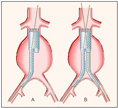 <p>endovascular aortic repair (EVAR)</p>