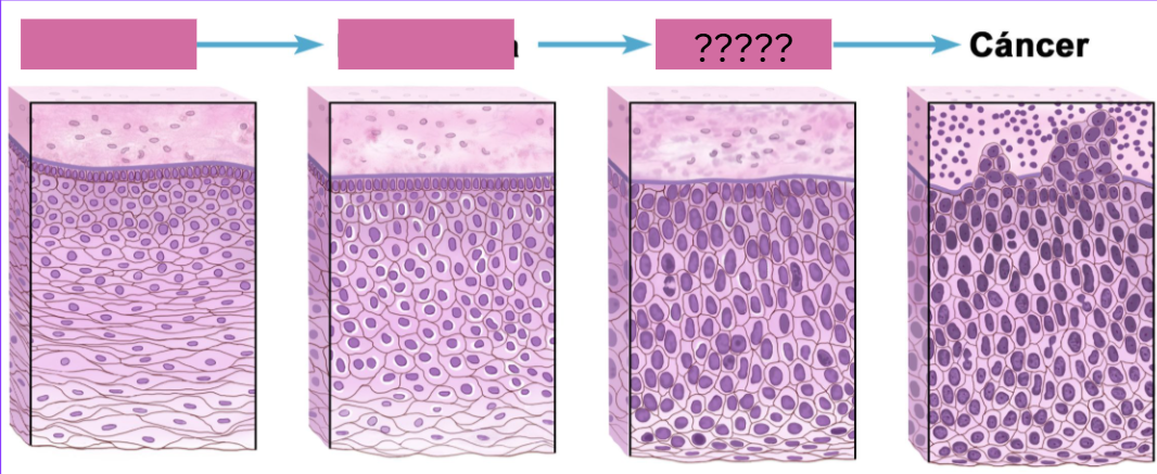 <p>Característica histológica a neoplásicas y <strong>crecimiento desorganizado e ilimitado de células</strong>, cómo se llama dicha fase:</p>
