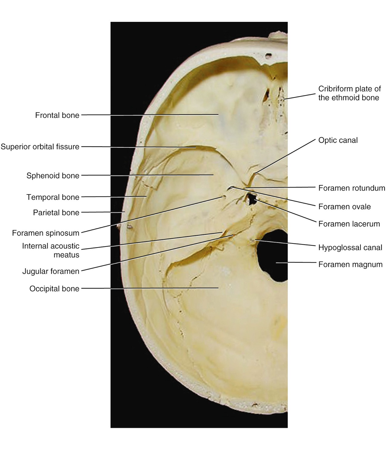<p>Internal Acoustic Meatus (IAM) #49</p>