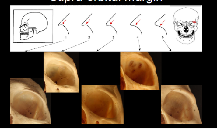 <p>Supra-Orbital Margin - Cranial </p>