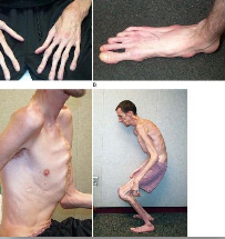 <p>Marfan Syndrome</p>