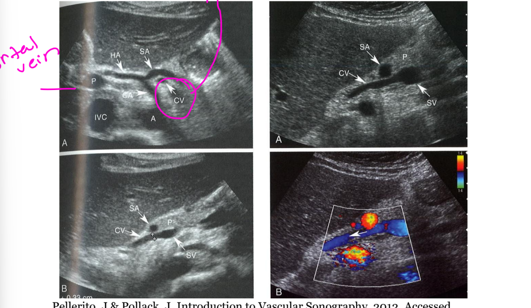 <p><br>It is seen superior to the splenic artery and anterior to the celiac axis or posterior to the common hepatic artery or splenic artery.</p><p><br><br>It should not exceed <strong>5–6 mm</strong>.</p><p><br><strong>Reversed flow</strong> is an early sign</p><p></p><p>When pressure gets too high in the portal system, blood has trouble passing through the liver. The body opens or enlarges other veins to create <strong>detour pathways around the liver</strong>.</p><p>So:</p><p><strong>Portal hypertension → blood backs up → collateral veins develop/enlarge → blood is redirected around the liver</strong></p>