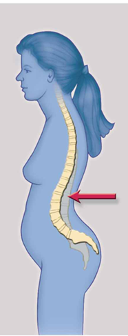 <p>Lordosis</p>