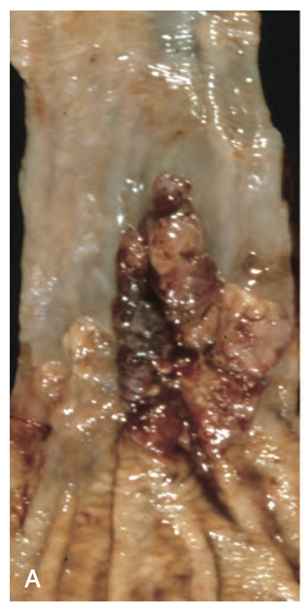 <p>diagnosis, esophageal tumor</p>