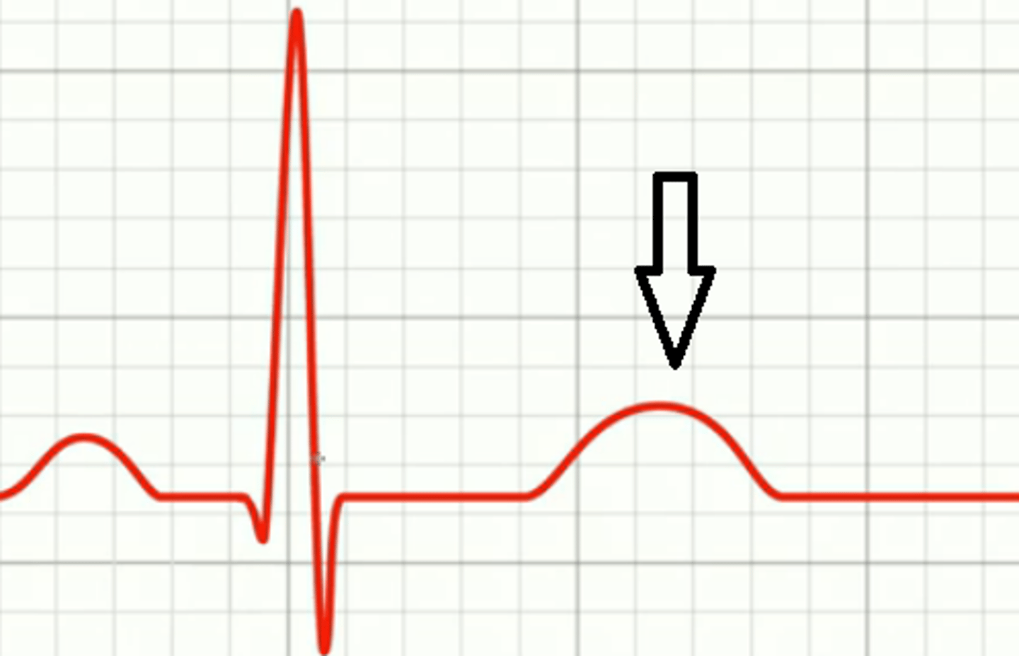 <p>ventricular repolarization (relaxation); tells ventricles to relax; pulls blood in</p>