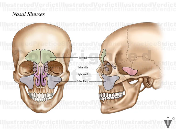 <p>an air filled cavity within a bone, lined by mucus membrane</p>