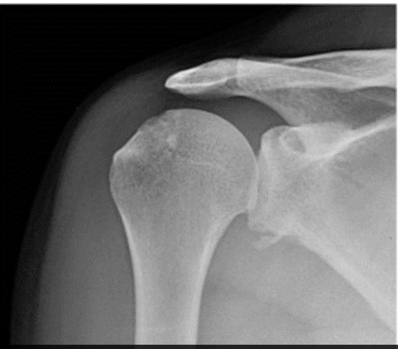 <p>Damage to inferior glenoid after anterior dislocation</p><p></p>