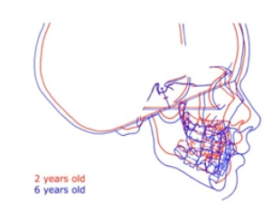 <ul><li><p>cephalometric superimposition of the same individual at 2 and 6 yrs of age</p></li><li><p>superimp - over stable landmark (sella turcica)</p></li><li><p>cranial base lengthened (brain mass inc. during this time - enlarged cranial vault)</p></li><li><p>maxilla and midface - pushed forward</p></li><li><p>mandible - moved down and forward</p></li><li><p>face grew more than cranium</p></li></ul><p></p>