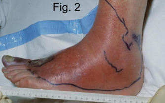 <p><strong>Definition:</strong> An acute bacterial infection of the dermis and subcutaneous tissue</p><p><strong>PC:</strong> Hot, red, swollen, painful skin. Usually lower limb. Can present blisters, fever, malaise, nausea</p><p><strong>Common pathogens:</strong> Staphylococcus aureus, Streptococcus pyogenes</p><p><strong>Differential diagnoses: </strong>Deep vein thrombosis, septic arthritis, gout</p><p></p>