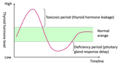 <p>aka viral thyroiditis. granulomatous or deQuervain's thyroiditis. </p><p>From an infection ex: EBV, coxsackie --> abrupt onset of thyroiditis. They will have fever, malaise, thyroid/jaw pain, weight loss (s/s of hypothyroid). High ESR and TSH, low T3 and T4</p><p>Treatment: Steroids! (can also give aspirin and NSAIDs and BBs) - no surgery </p><p>Note: this will not have antithyroid antibodies since it is not autoimunne, rather it is an acute *inflammatory dz*</p>