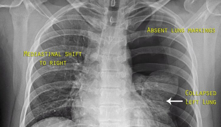 <p><span>Pneumothorax + <strong>mediastinal/tracheal shift AWAY</strong> from affected side </span></p><p class="MsoNormal"><span>• Depressed ipsilateral diaphragm</span></p><p><span style="font-family: "Times New Roman", serif;">• Widened intercostal spaces</span></p><p></p>