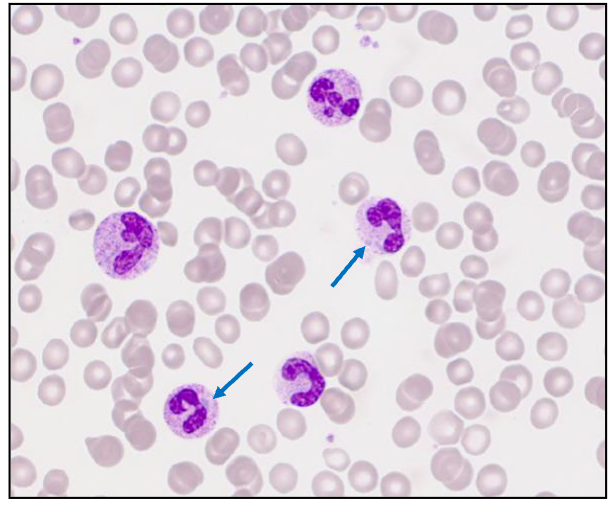 <p>Severe Bacterial Infection: Dohle Bodies</p>