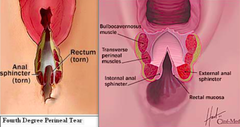 <p>Also involves the anterior rectal wall torn</p>