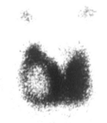 <p>Nonfunctioning or poorly functioning areas of the thyroid that take up little radioactive iodine in a nuclear medicine scan. </p><p>Can indicate a cyst, blood, scar tissue, the thyroid gland suppressed by nearby autonomous thyroid gland, or thyroid cancer. </p><p>-more suspicious for thyroid cancer BUT, only 30% of cold nodules are malignant.</p>