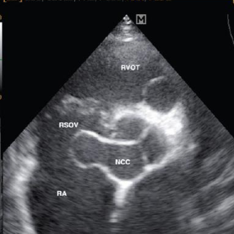 <ul><li><p>rare congenital anomaly seen on <strong>PSAX or PLAX</strong></p><ul><li><p>not medical emergency because born with it! → still report </p></li></ul></li><li><p>weakening or absence of the media layer</p></li><li><p>weakened sinus dilates and forms an aneurysm, can cause holes</p></li></ul><p></p>