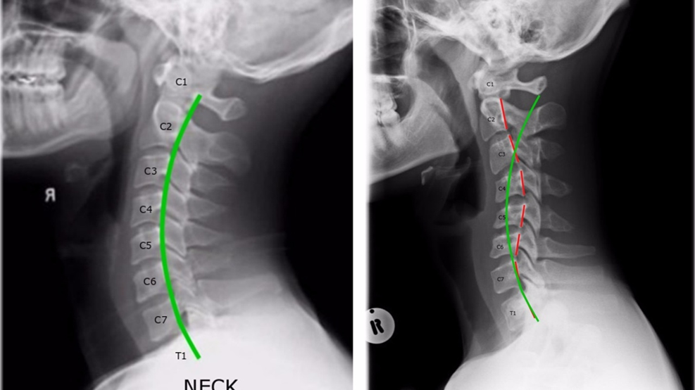 <p>hyperextension injury- radiographic appearance </p>