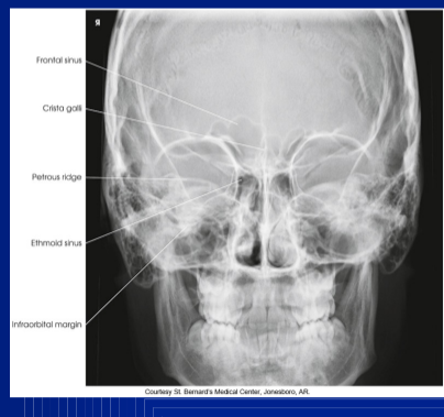<p>PA AXIAL (CALDWELL) FACIAL BONES</p>
