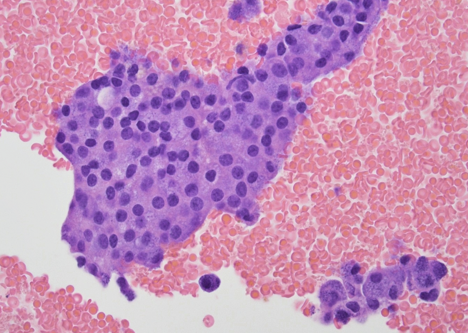 <p>1) Malin</p><p>2) Carcinome à cellules acinaires</p>