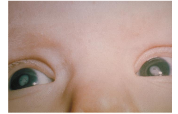 <p>classic galactosemia</p>