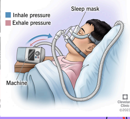 <ul><li><p>Bilevel Positive Airway Pressure</p></li><li><p><span>Pressure-supported, noninvasive ventilation that provides positive inspiratory and end-expiratory pressure</span></p></li><li><p><span>May be used to avoid intubation and mechanical ventilation</span></p></li><li><p><span>Often used in the hospital or home setting for the management of obstructive sleep apnea</span></p></li><li><p><span>Fio2 - 21 to 100%</span></p></li></ul><p></p>