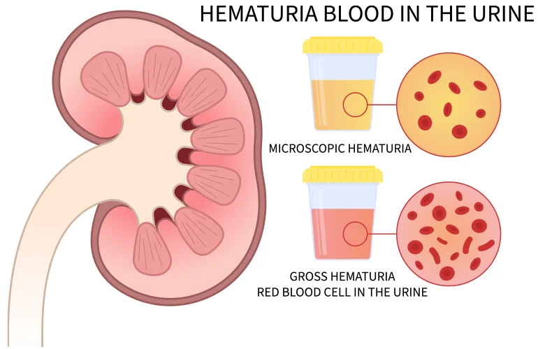 <p>A condition in which waste products (like urea) build up in the blood due to kidney failure.</p>