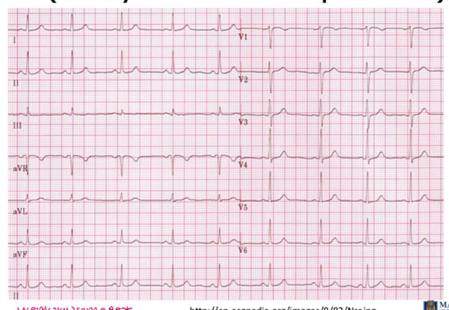 <p>what kind of ECG is this?</p>